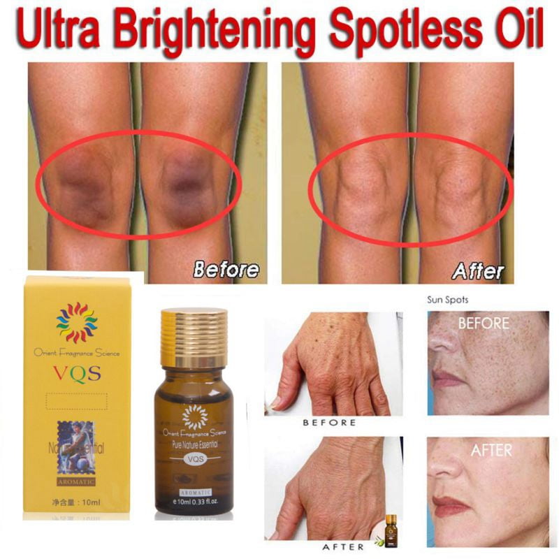 Ultra Brightening Spotless Oil Remove Dark Spots Age Spots Hyper
