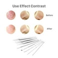 thumbnail image 3 of Herramienta para quitar espinillas, extractores de acné, removedor de imperfecciones, pinzas para pelo encarnado, Kit de eliminación de espinillas, removedor de espinillas 8 en 1, 3 of 5