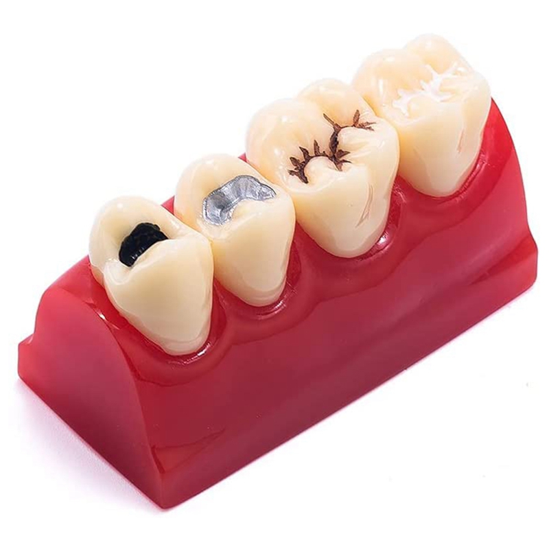 Dental Pathology Teeth Model Sealant Demonstration Tooth Model for