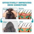 thumbnail image 4 of Anti-Dandruff Hair Shampoo Anti-Itch Scalp Psoriasises Shampoo Dandruff Treatment Deep Cleansing Hair Wash for Men Women, 4 of 5