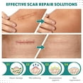 thumbnail image 6 of Silicone Scar Sheets, Silicone Scar Tape(1.6” x 120” Roll-3M), Scar Removal Away Strips for Surgical Scars, Keloid, C-Section, Burn et, 6 of 7