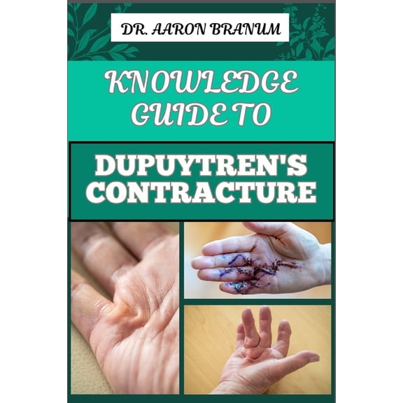 Knowledge Guide to Dupuytren's Contracture: Comprehensive Manual To Symptoms, Treatments, And Preventative Care For Hand, (Paperback)