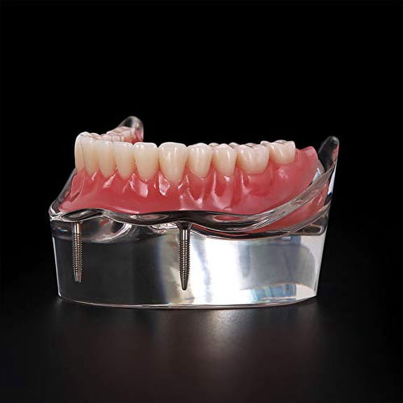 Dental Implant Teeth Demo Model Overdenture Restoration with 2 Implants Model M6002