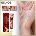thumbnail image 3 of Crema para aliviar el dolor de piernas de 20g ungüento eficaz para el tratamiento de las venas varicosas a base de hierbas uso externo de la piel ungüento para la fatiga cuidado de la salud, 3 of 9