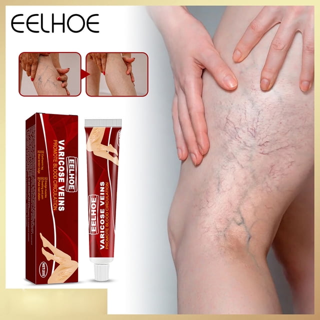 Crema para aliviar el dolor de 20g para las piernas ungüento para el tratamiento de las venas varicosas uso externo de la piel crema para eliminar la angiitis varicosa cuidado de la salud