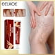 thumbnail image 3 of Crema para aliviar el dolor de piernas de 20g ungüento eficaz para el tratamiento de las venas varicosas a base de hierbas uso externo de la piel ungüento para la fatiga cuidado de la salud, 3 of 9
