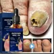 thumbnail image 2 of Gel antiinfección para eliminación de hongos en las uñas, 10ML, tratamiento de uñas por hongos, reparación de pies, eliminación de hongos en las uñas de los pies, 2 of 5