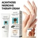 thumbnail image 4 of Crema de tratamiento de terapia de acantosis nigricans, crema reparadora de piel de espina negra, crema hidratante blanqueadora correctora de manchas oscuras, 4 of 5