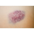 thumbnail image 5 of Miracle Plus Arnica Bruise Gel for Bruising, Swelling, Discoloration. Warming Gel to Ease Pain. Two Pack 4 fl oz, 5 of 6