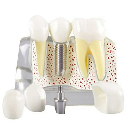 

Teeth Demonstration Model Implant Removable Analysis Crown Bridge for Doctor-Patient Communication Transparent