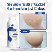 Footlogix Cracked Heel Cream – Intensive Moisturizing Foot Repair for Dry, Rough Feet & Calluses, Fast-Absorbing, 4.23 oz