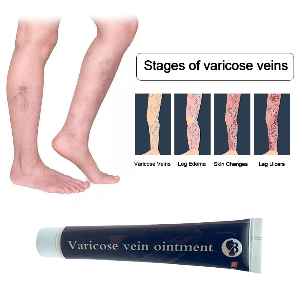 start stage varicose unguent ciorapi sigvaris în varicoza