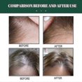 thumbnail image 3 of 50ml Hair Growing Spray Ginger King Anti-removal Spray Hair Raising Liquid Treatment Hair Loss, 3 of 5