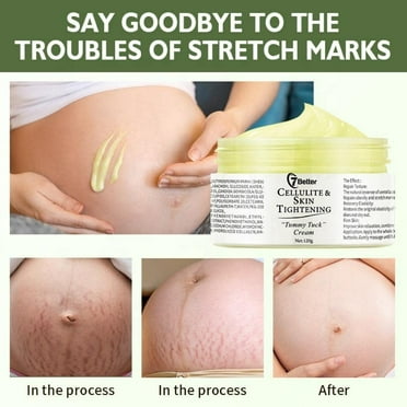 Postpartum Elegance Natural Deep Stretch Mark Removal Cream for Pregnancy - Scar Repair, Abdominal Firming, and Gentle Stretch Mark Eradication