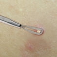 thumbnail image 3 of Beaute Galleria Stainless Steel Double Loop Pimple Remover, Blackhead, Blemish, Acne Extractor, 3 of 5