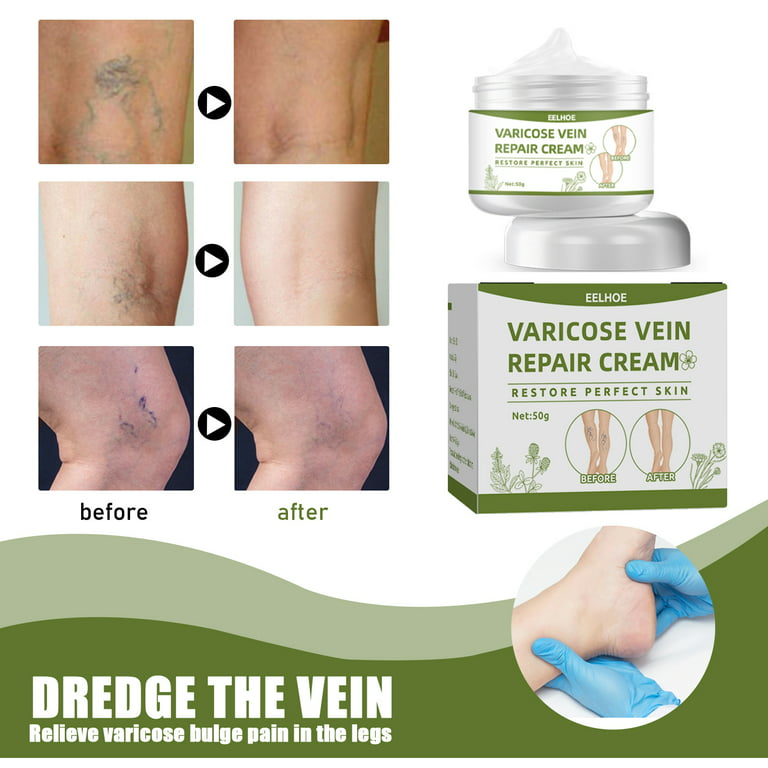  Varicose Veins Treatment for Legs - Healing Natural Oils  Formula, Anti Varicose Vein Soothing Leg Cream, Varicose Veins Treatment  for Legs（1.76 fl oz ） : Beauty & Personal Care