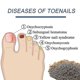 thumbnail image 3 of 96pcs Anti Fungal Nail Treatment-toe-fungus Onychomycosis Repair Sticker, 3 of 5