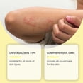 thumbnail image 2 of Psoriasis & Eczema Relief Cream Anti-Itch, Soothing & Moisturizing with Allantoin & Natural Extracts for Sensitive Skin, 2 of 5