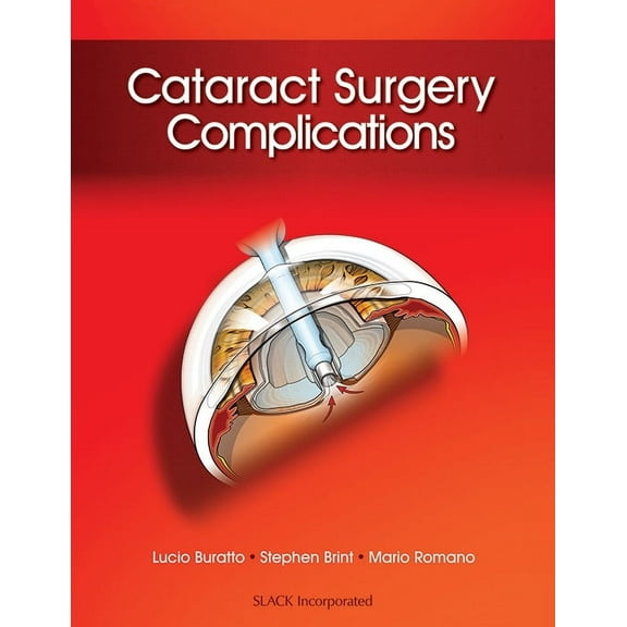 Cataract Surgery Complications (Hardcover)