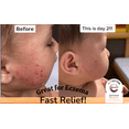 thumbnail image 4 of Eczemol OTC 8 fl. oz. Topical HydroGel - FDA Cleared Skin Healing Treatment for Eczema, First/Second Degree Burns, Skin Irritation, Cut/Wound Healing, Sunburn, Radiation Dermatitis, Skin Itching, 4 of 7