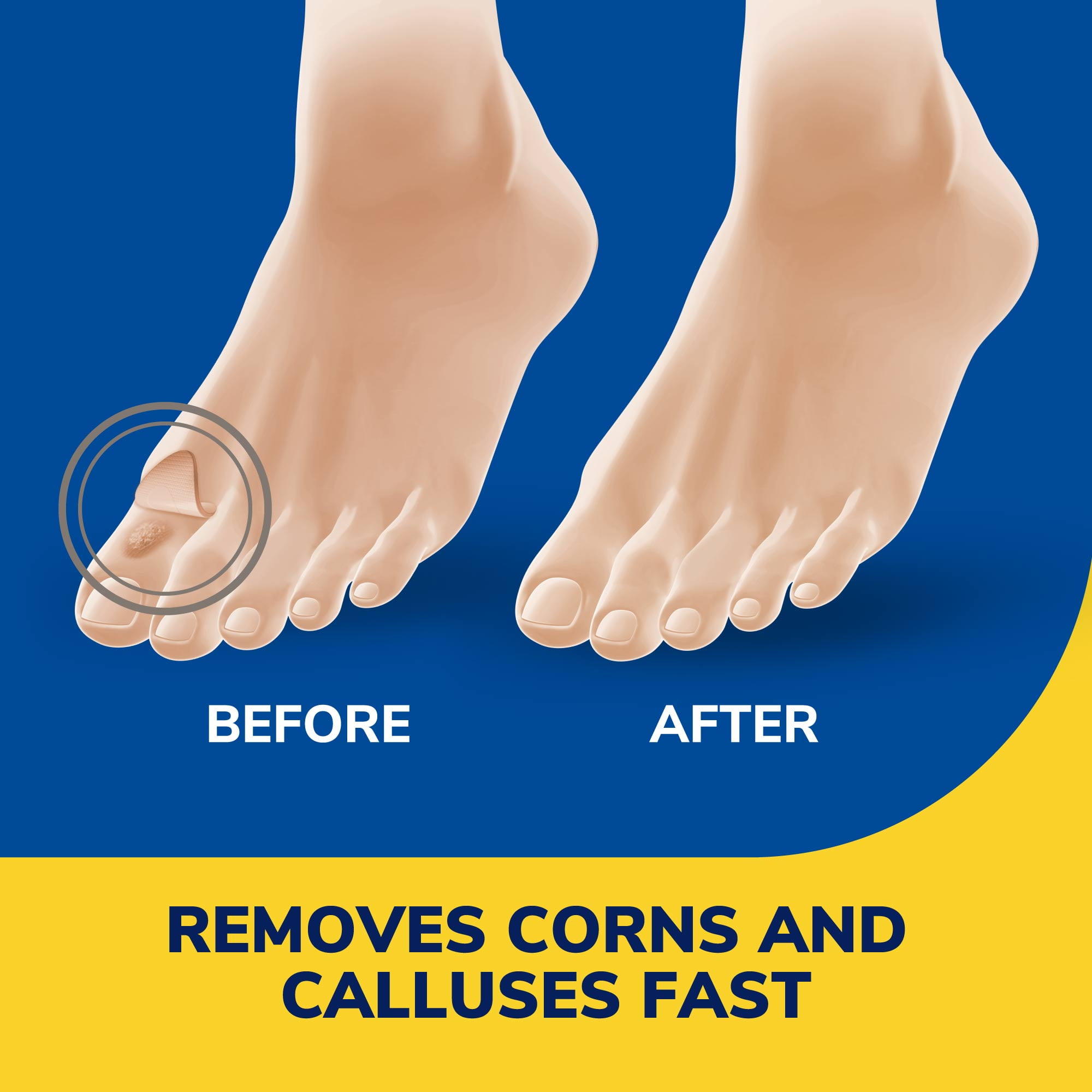 how to remove calluses #callusremoverhealth