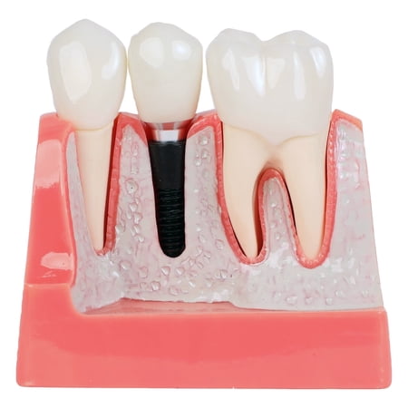 Axis Scientific Enlarged Dental Implant Anatomy Model - Human anatomy system miniature  demonstration skill  educational model Includes Product Manual  scientific anatomy model  mini figure price history on PriceWatchPro