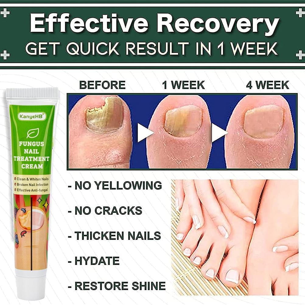 How to Cure Nail Fungus - YouTube