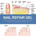 thumbnail image 5 of Healio Nail Treatment Gel ,foot Care Gel Anti Infection Thicken Soft Nails, 5 of 5