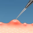 thumbnail image 4 of Woeilo 2 Pack Pimple Popper Tool Blackhead and Blemish Remover Extraction Tools for, 4 of 5