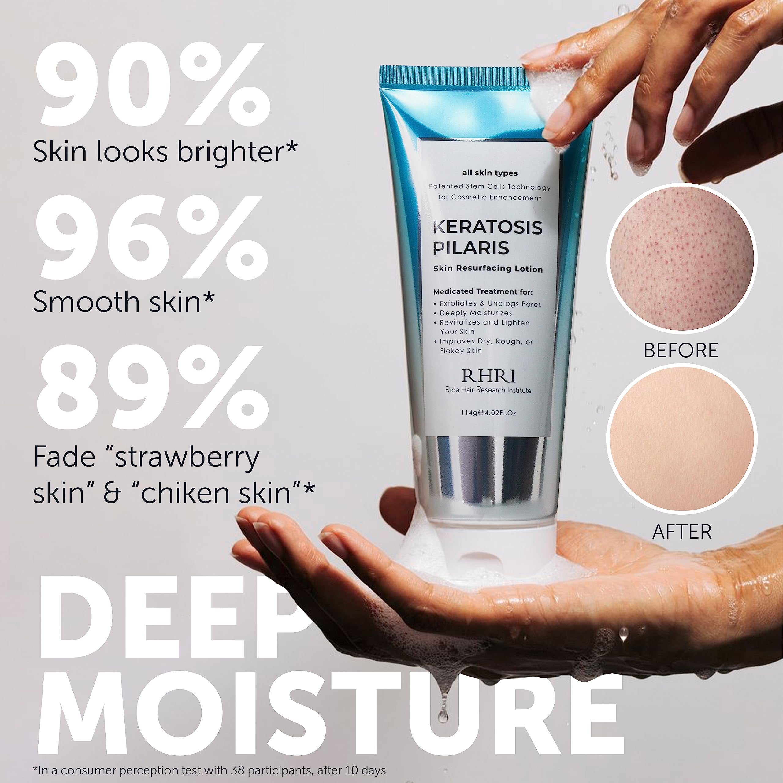 KP Bump Eraser Lotion Keratosis Pilaris Lotion with Glycolic Acid, AHA & BHA Exfoliating Rough & Bumpy Skin Body Lotion