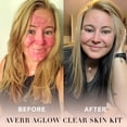 thumbnail image 4 of Kit de Cuidado Facial Averr Aglow Natural, Tratamiento de Acné para Control de Imperfecciones y Redu, 4 of 9