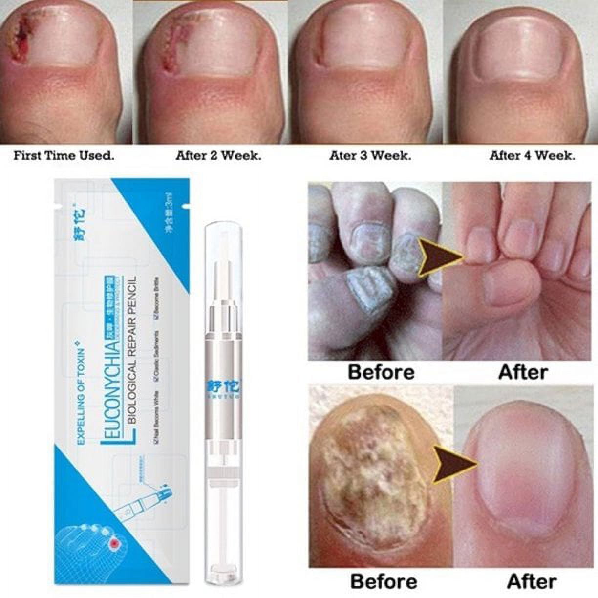 Nail Repair Cream, Effective Toenail Fungus Treatment Fungus Remover Foot  Nail Repair Cream - Walmart.com