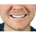 thumbnail image 2 of Natural Shade - Upper Veneer Cosmetic Teeth, 2 of 5