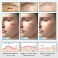 thumbnail image 6 of 1.5M×2.5Cm Silicone Scar Tape Roll | Reusable Scar Removal Patch, Keloid Scar Strips | Application (35G), 6 of 9