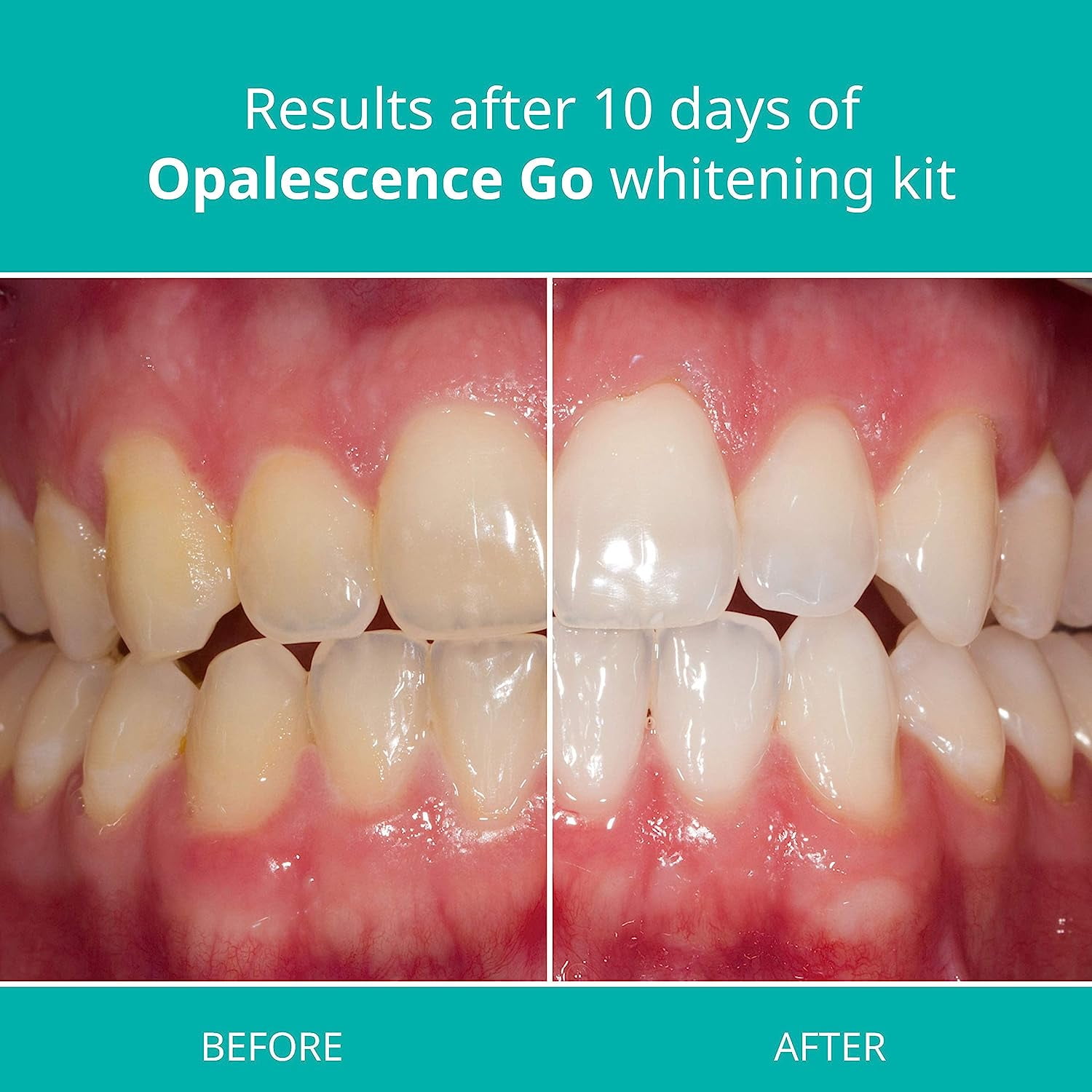 Opalescence Go 10% Prefilled Teeth Whitening Gel Trays Kit (10 Treatments) Mint Hydrogen Peroxide