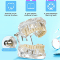 Disease Teeth Model Dental Typodonts Implant with Removable Dentist
