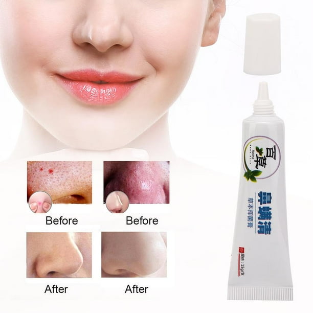 OTVIAP 15g Efficient Mites Remove Red Nose Blackhead Rosacea Cream