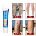 thumbnail image 4 of Crema Para Venas Varicosas, Fuerte Penetración, Ingredientes Naturales, Cuidado De Las Piernas, Crema Varicosa, 20g, 4 of 7