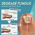 thumbnail image 6 of Uytogofe Gel Toe Removal Nail Feet Care Nail Personal Skin Care, 6 of 8