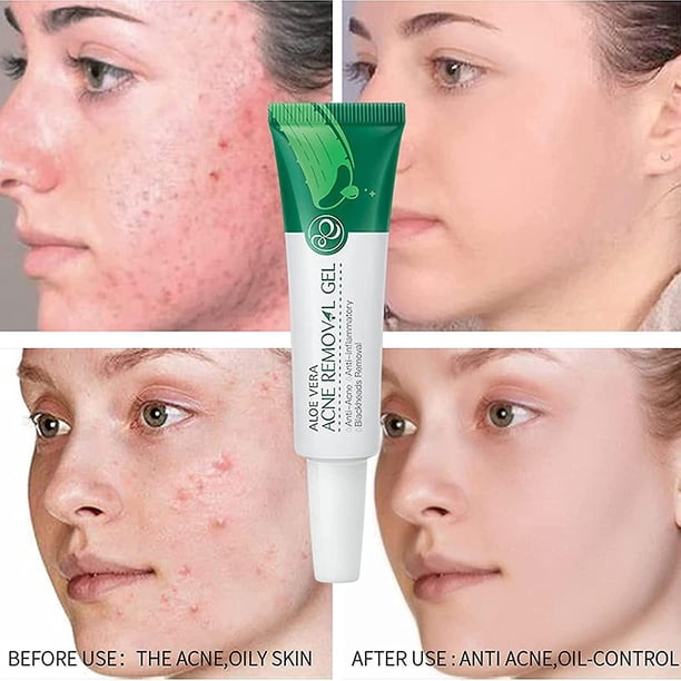 Aloe Vera Acne Serum Gel, Natural Aloe Acne Removal Gel Serum, Aloe Vera Gel  For Face Soothing Face Care - Walmart.ca