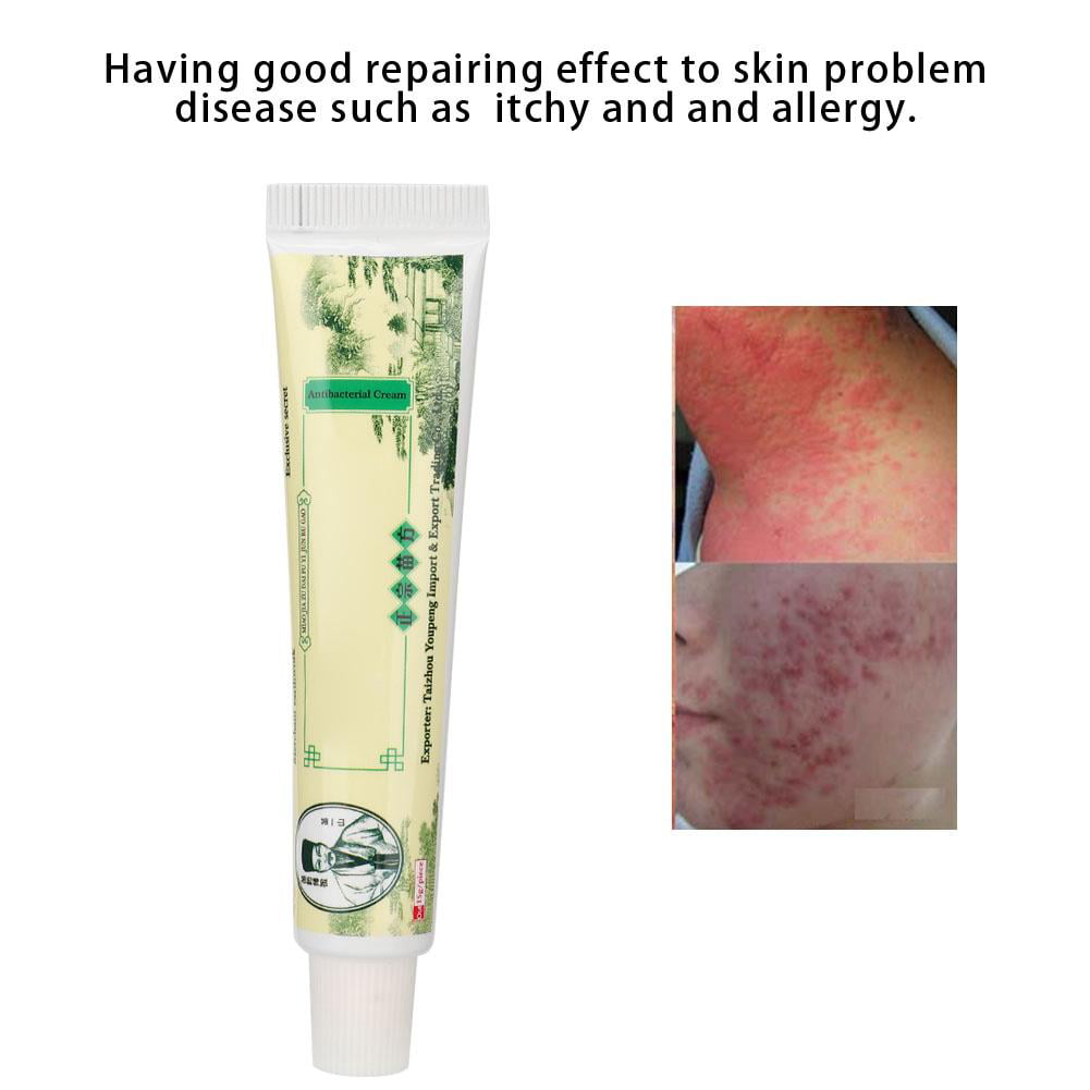 1x Psoriasis Skin Cream For Chinese Herbal Antibacterial Ointment Skin Problems’ 