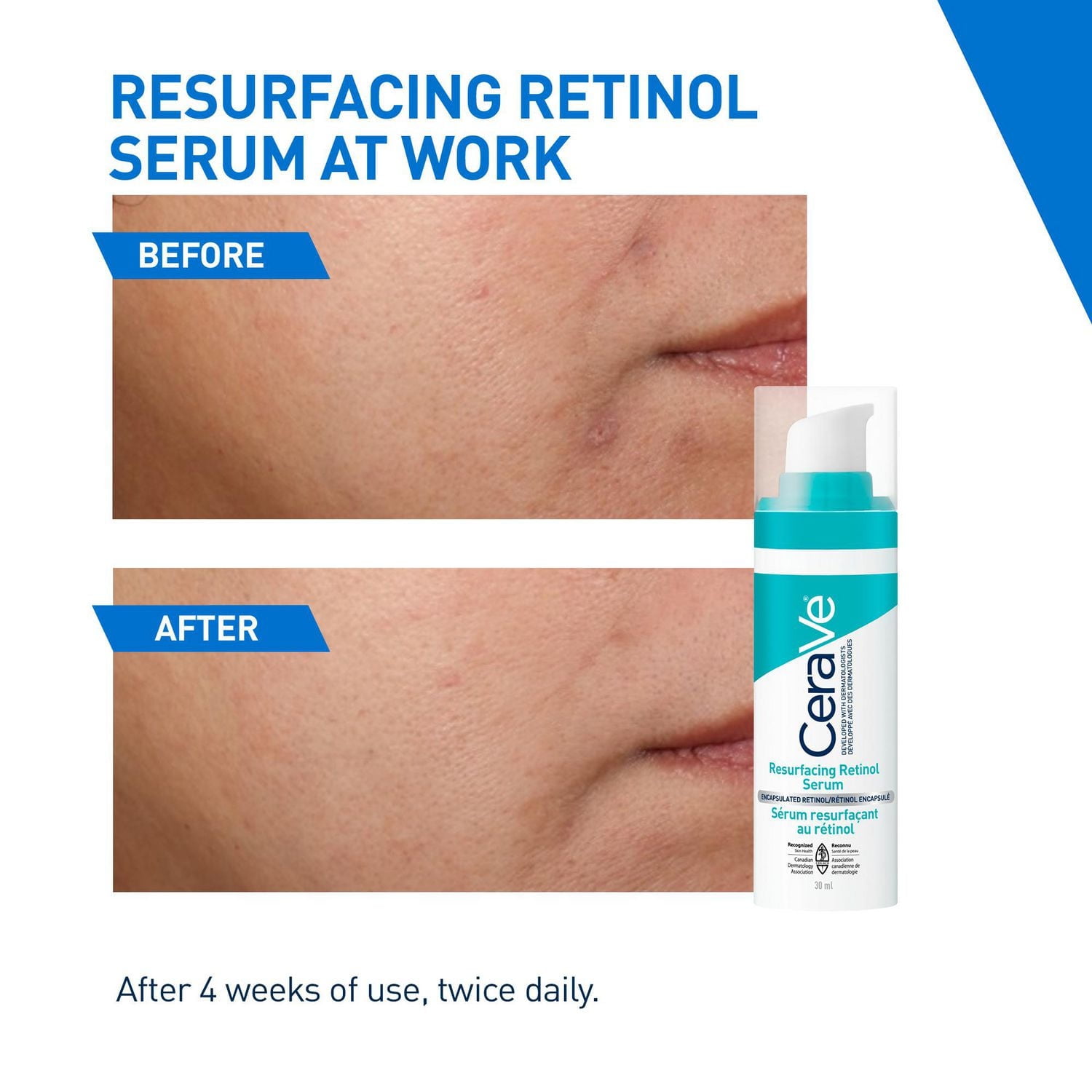CeraVe Resurfacing Retinol Serum for Face with Niacinamide & Encapsulated Retinol. Helps even Skin Tone, Improve Skin Smoothness & Reduce Post-Acne Marks. Gentle, Fragrance-free, & Non-Comedogenic, 30, A full-face lightweight serum