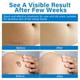 thumbnail image 7 of Keloid Bump Removal Gel. Silicone Scar Treatment - Professional Scar Cream for Old & New Scars - 20ml, 7 of 7