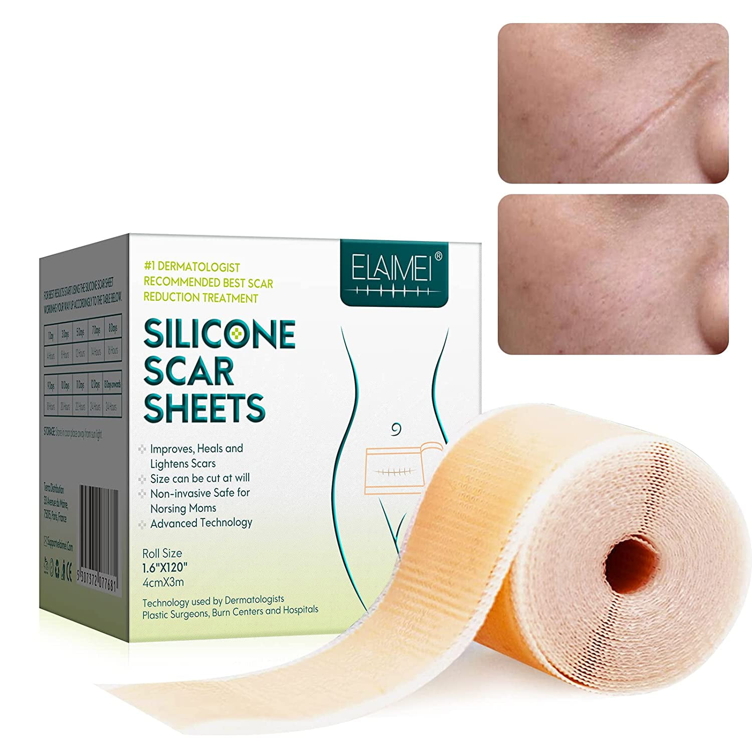 Skywee Silicone Scar Sheets,Softens And Repairs Scars,Used For Scars Caused By Injuries, Burns, Acne, C-Section Surgery And Stretch Marks(1.6” x 120”)