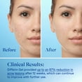 thumbnail image 6 of Differin Acne Treatment Gel with 0.1% Adapalene, Prescription-Strength Retinoid Clears & Prevents Acne, Fragrance-Free, 1.6 oz (45g) Pump ​, 6 of 15