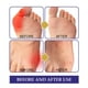 thumbnail image 4 of Parche Para Juanetes 5 uds juanete gota alivio del dolor parche dedo del pie articulación Valgus Hallux rodilla artritis Lumbar, 4 of 7
