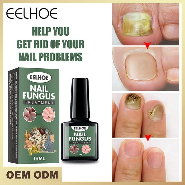 Onicomicosis Líquido Manos Y Pies Onicomicosis Cuidado Reparación Degerm Onicomicosis Líquido Espesar Uñas Suaves-15ml