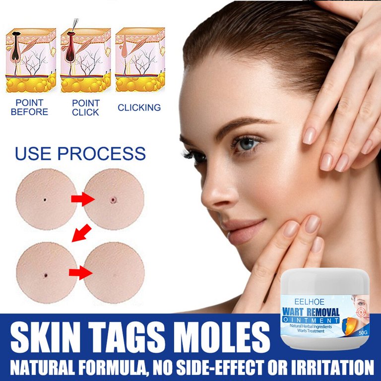 Eelhoe Wart Remover Ointment Side Effects