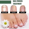 thumbnail image 5 of Nail Fungus Treatment, 50ml Toenail Fungus Treatment, Extra Strong Nail Repair Solution with, 5 of 5