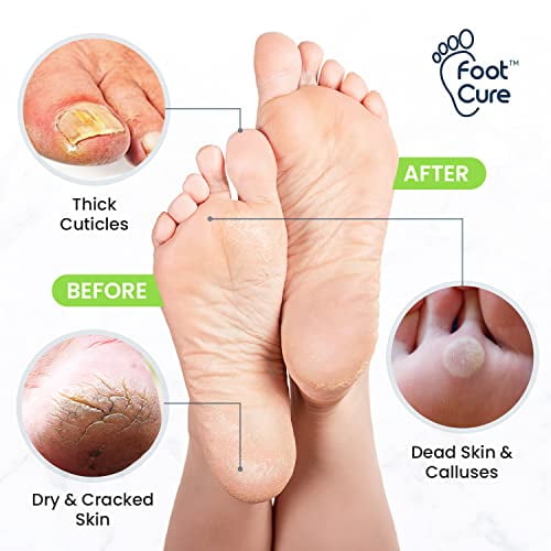 Foot soak for cracked heels discount